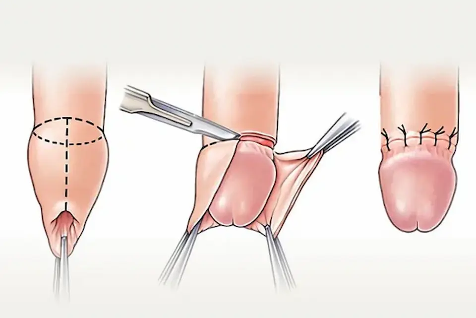 Pré-operatório de postectomia