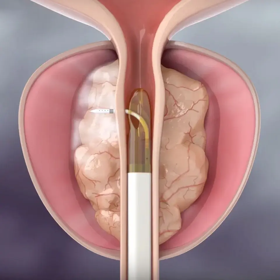 Tratamento da próstata com REZUM