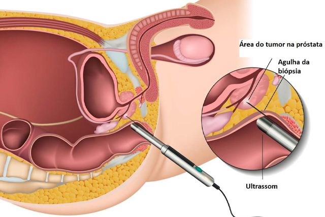 Imagem-resseccao-endoscopica-da-prostata